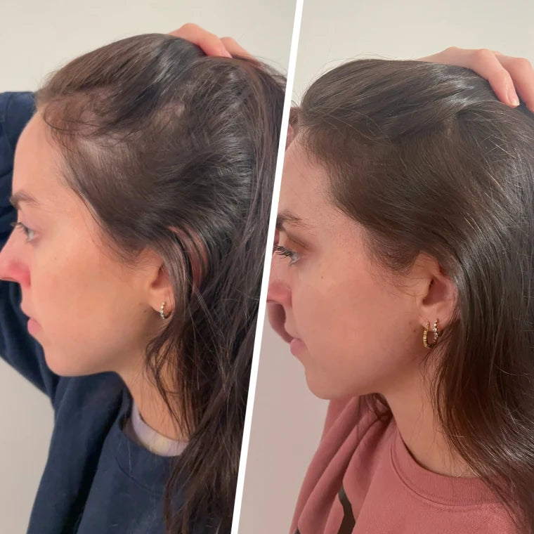 Red Light Therapy Hat for Hair Regrowth Treatments